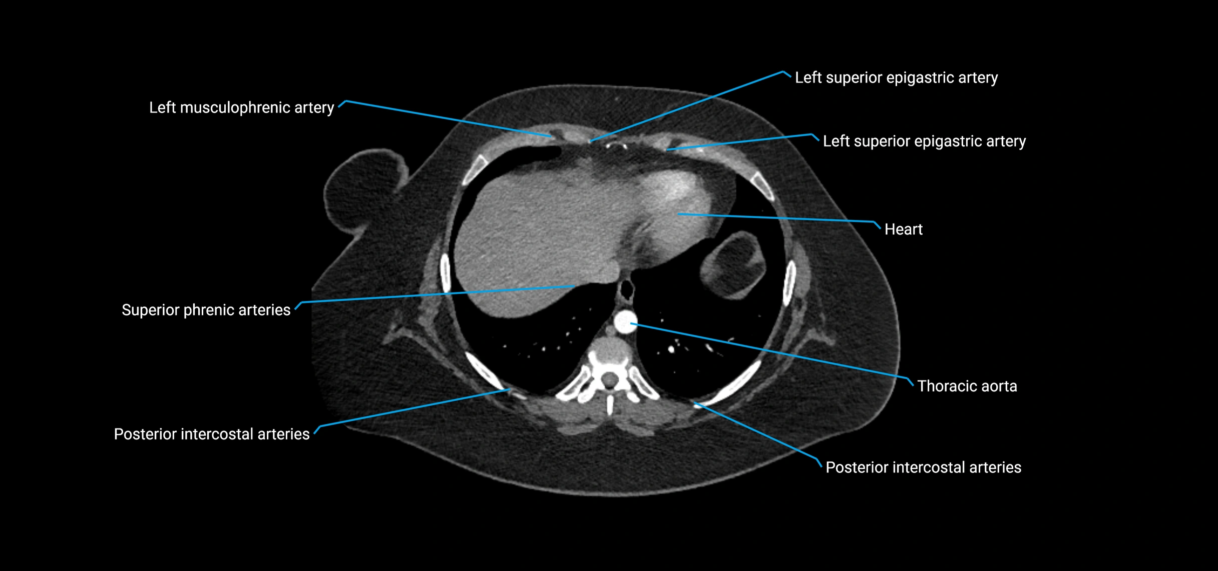 CTA abdomen axial cross sectional anatomy labelled image_14 (2).webp